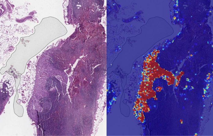 Google AI Can Identify Advanced Breast Cancer More Accurately Than Human Doctors