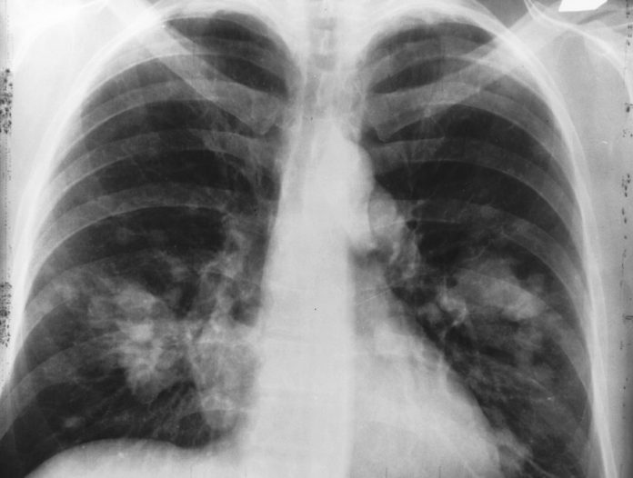 New AI Claims of Detecting Lung Cancer with 97% Accuracy