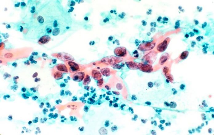 AI Outperforms Doctors in Cervical Cancer Detection
