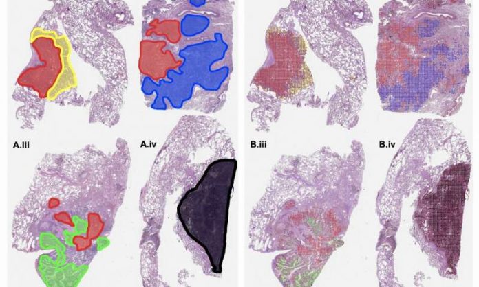 Machine Learning Model Can Grade Cancer Slides at Pathologist Level